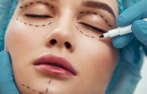 Blepharoplastik